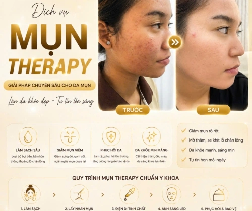MỤN KHÔNG PHẢI BẠN THÂN, SAO CỨ BÁM THEO MÌNH MÃI?