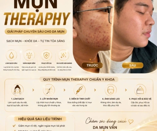 MẶT ĐANG ĐẦY MỤN? ĐỪNG VỘI NẶN TẠI NHÀ!