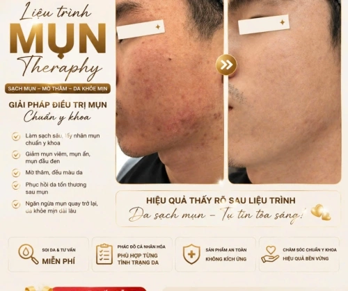 ĐỪNG ĐỂ MỤN LẤY ĐI SỰ TỰ TIN CỦA BẠN!