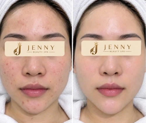 JENNY BEAUTY SPA – CHĂM SÓC DA MỤN, NÂNG NIU LÀN DA