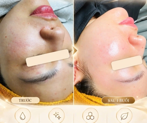 SAU 1 BUỔI CHĂM SÓC – DA CĂNG BÓNG, MỊN MÀNG HƠN