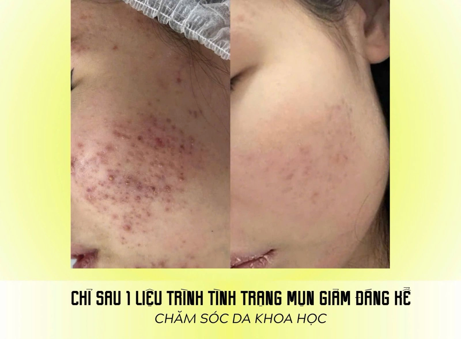 điều trị mụn Acnes OPT tại Jenny Beauty