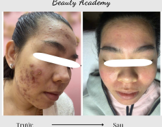 Điều Trị Mụn Acnes OPT An Toàn Tại Quận 10 | Jenny Beauty