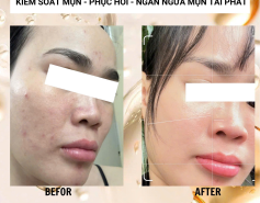 Spa Trị Mụn Chuẩn Y Khoa Tại Quận 10 – Giải Pháp An Toàn Cho Làn Da Khỏe Mạnh