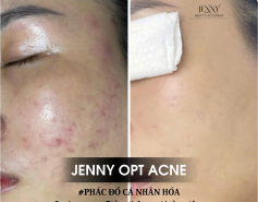 ? JENNY OPT ACNE – PHÁC ĐỒ CÁ NHÂN HÓA ? Không chỉ làm sạch mụn,