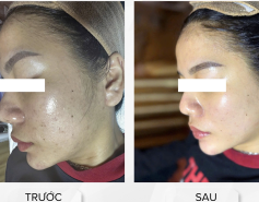 CẢI THIỆN 95% DA MỤN SAU LIỆU TRÌNH TẠI JENNY BEAUTY SPA