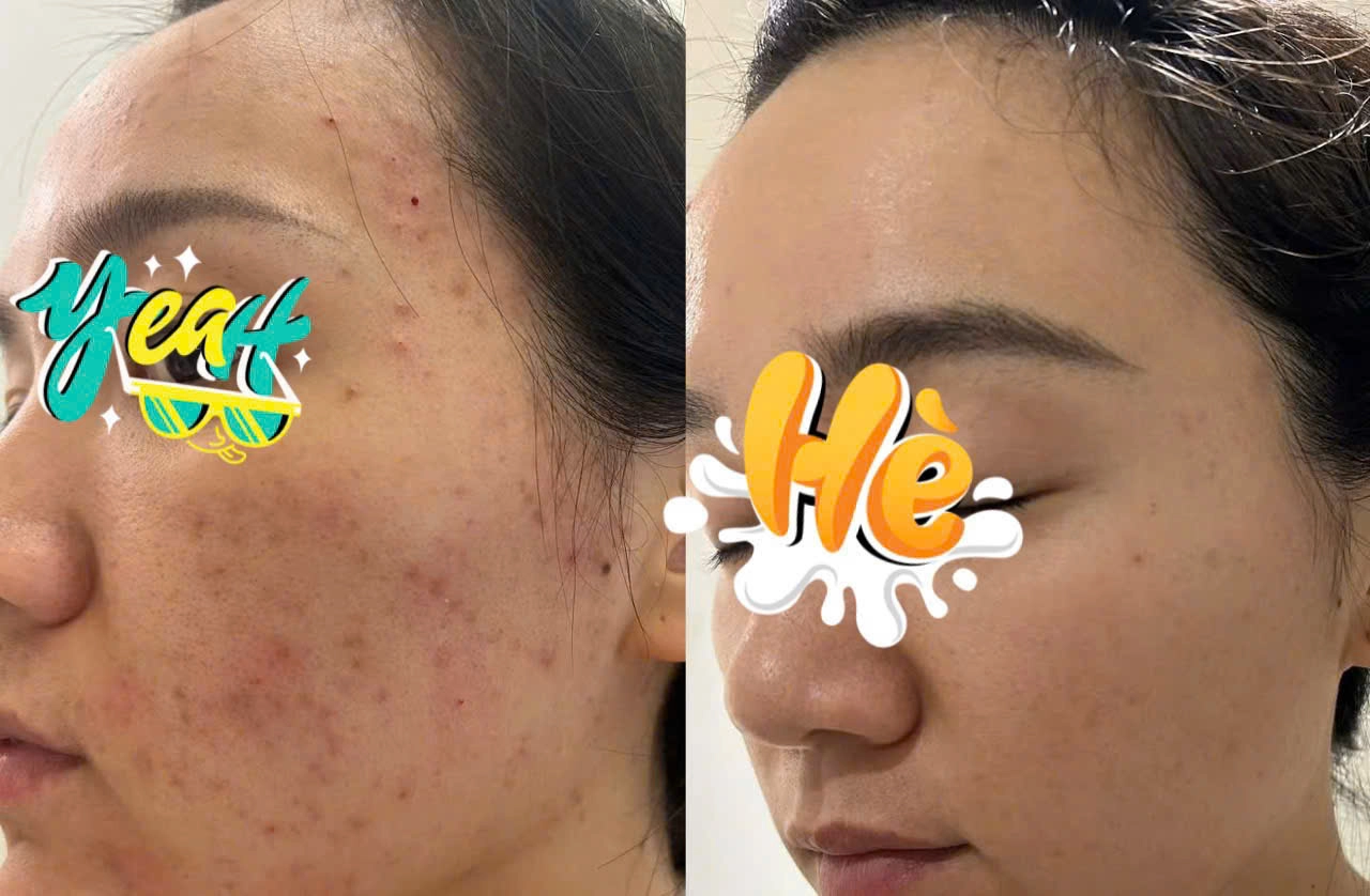 Kết quả trị mụn hiệu quả với chi phí hợp lý tại Jenny Beauty Quận 10.