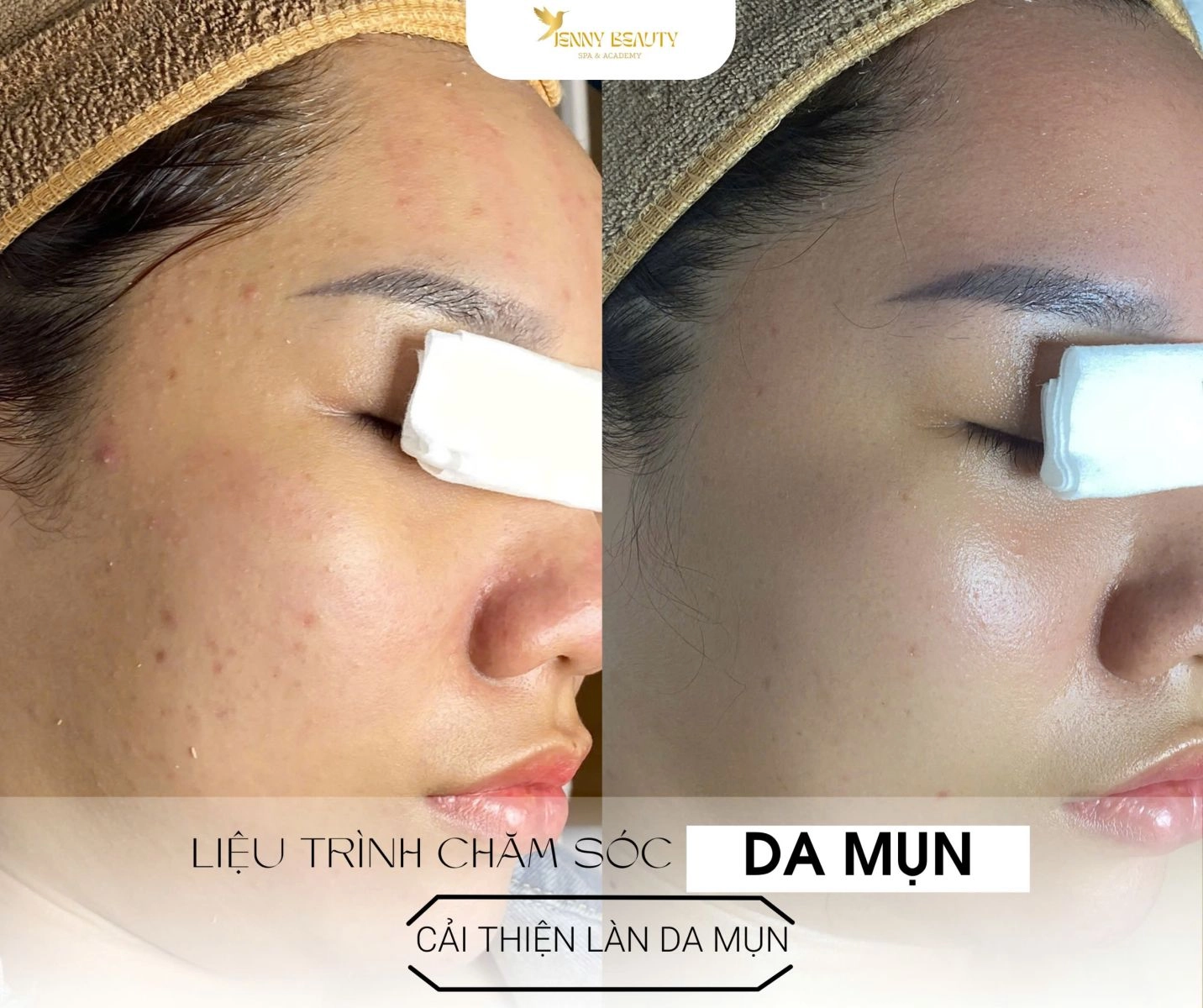 Hình ảnh trước và sau liệu trình Mụn Detox CO2 tại Jenny Beauty, minh chứng hiệu quả trị mụn và thanh lọc da.