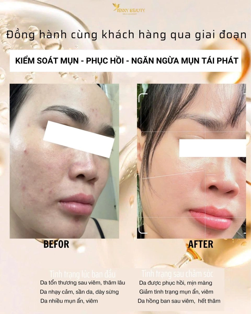  Hình ảnh trước và sau liệu trình spa trị mụn chuẩn y khoa tại Jenny Beauty Quận 10, minh chứng hiệu quả.