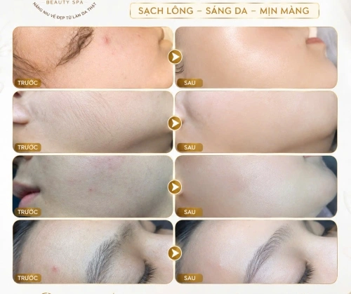 TRIỆT LÔNG CÔNG NGHỆ BĂNG TUYẾT – GỌN GÀNG, MỊN MÀNG HƠN TẠI JENNY BEAUTY SPA