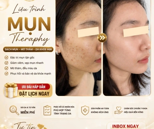 MỤN LÌ LỢM? ĐỪNG ĐỂ LÀN DA 