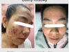 Điều Trị Mụn Acnes OPT An Toàn Tại Quận 10 | Jenny Beauty