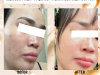 Kiểm Soát Mụn - Phục Hồi - Ngăn Ngừa Tái Phát: Phác Đồ Toàn Diện Tại Jenny Beauty