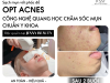 ✨ MỤN OPT ACNES – PHÁC ĐỒ CHUẨN Y KHOA ✨ Công nghệ quang học hiện đại, giúp giảm viêm – gom cồi – làm sạch mụn nhanh chóng.