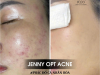 🌿 JENNY OPT ACNE – PHÁC ĐỒ CÁ NHÂN HÓA 🌿 Không chỉ làm sạch mụn, 