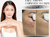 💆‍♀️ CHĂM SÓC DA MỤN – THERAPY ACNE 💥