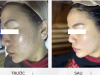CẢI THIỆN 95% DA MỤN SAU LIỆU TRÌNH TẠI JENNY BEAUTY SPA