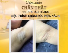 Peel nách tại Jenny Beauty – Giảm thâm, sáng da rõ rệt
