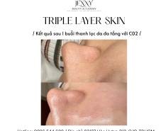 ✨ Therapy mụn CO2 detox ✨ 