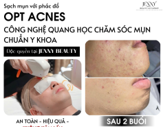 ✨ MỤN OPT ACNES – PHÁC ĐỒ CHUẨN Y KHOA ✨ Công nghệ quang học hiện đại, giúp giảm viêm – gom cồi – làm sạch mụn nhanh chóng.