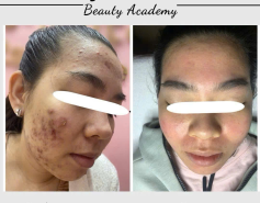 Cấp tốc dọn sạch mụn chỉ #999K – Da kịp đẹp đón Tết 🎋✨ CẢI THIỆN 99% DA MỤN SAU LIỆU TRÌNH TẠI JENNY BEAUTY SPA