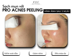 PRO ACNES PEELING – Giải pháp sạch mụn thần tốc ✨
