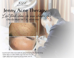 ​  Jenny Acne Therapy   Liệu trình chăm sóc mụn chuyên sâu – Chuẩn y khoa  ​