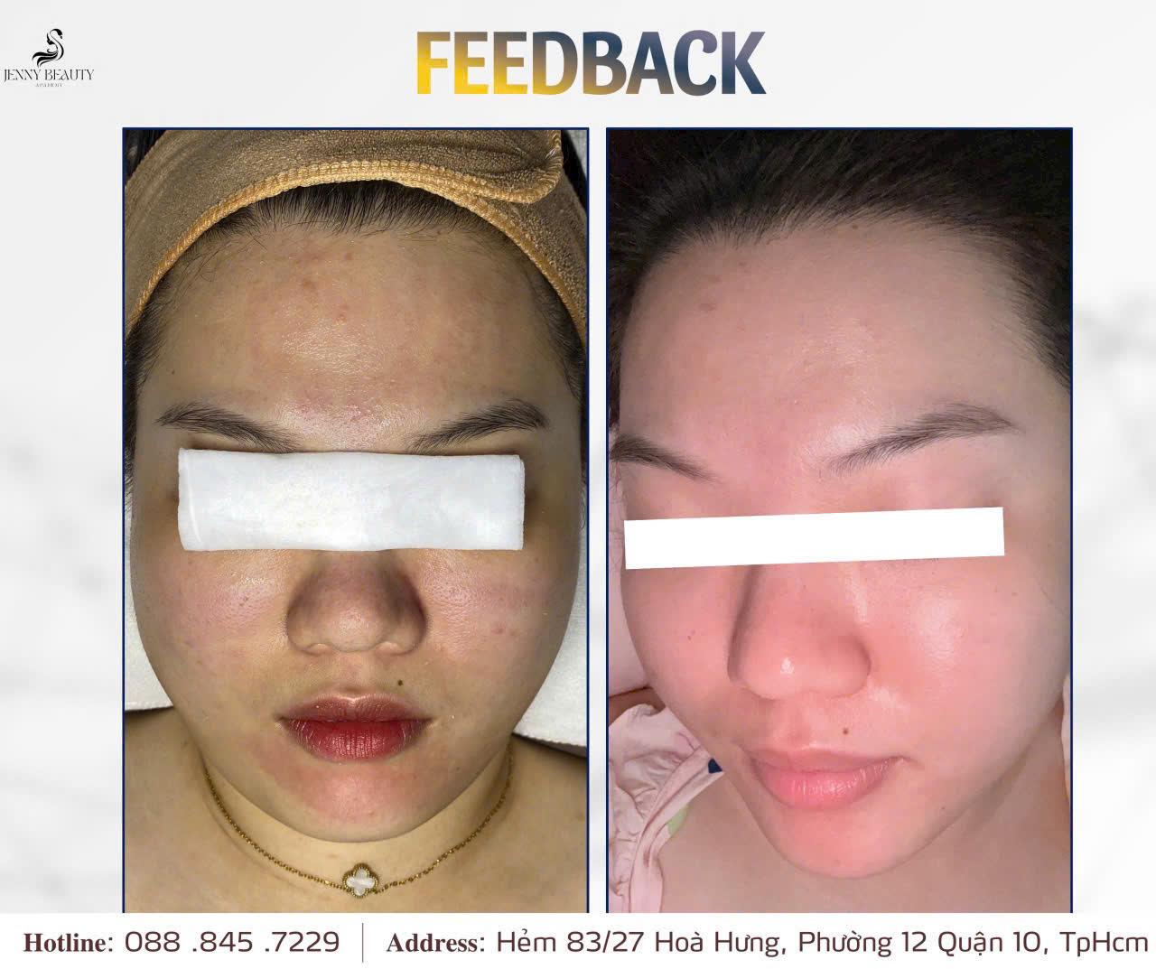 Hình ảnh trước và sau điều trị mụn công nghệ Acnes OPT an toàn tại Jenny Beauty Quận 10.